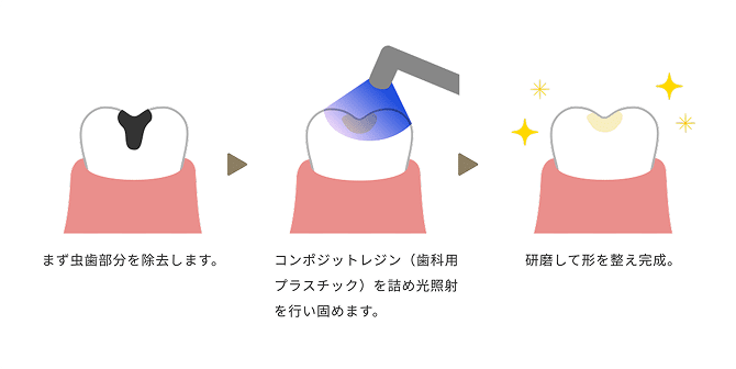 まず虫歯部分を除去します。 コンポジットレジン(歯科用プラスチック)を詰め光照射を行い固めます。 研磨して形を整え完成。